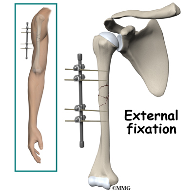 How long does it take to recover from a humerus bone fracture?