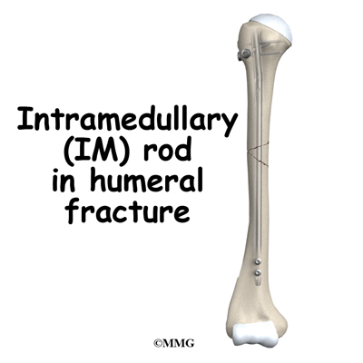 humerus intramedullary shaft rod fractures surgery fracture adult fixation im inside bone internal metal shoulder