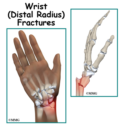 Image result for Distal Radius Fracture