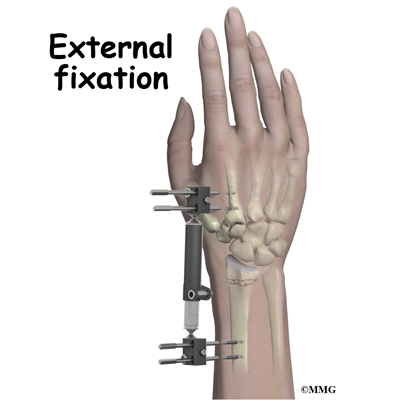 wrist radius distal fractures surgery adult treatment fx fixation fracture external metal device complications treatments conditions