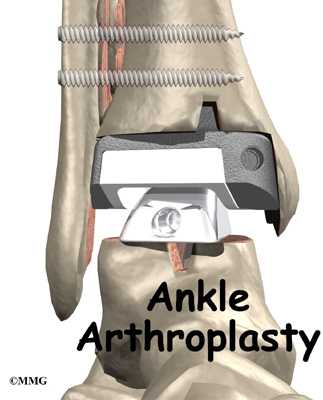 Are there any risks to total ankle replacement surgery?