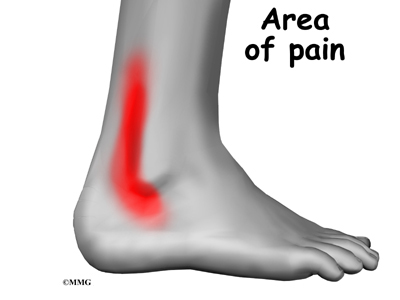 What are the symptoms of peroneal tendonitis?