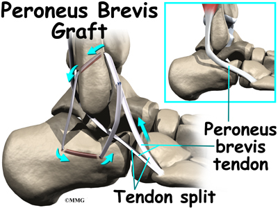 inversion ankle sprain. Ankle Sprain and Instability