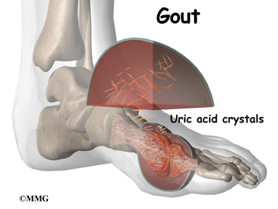 Gout vs Pseudogout | USMLEMD