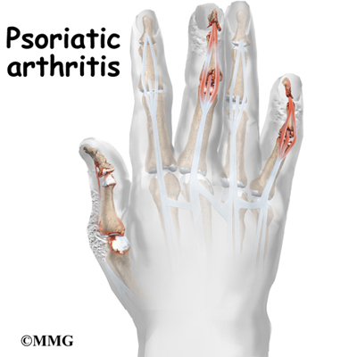 http://www.eorthopod.com/images/ContentImages/arthritis/arthritis_psoriatic/arthritis_psoriatic_intro01.jpg