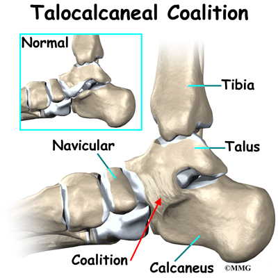 bones of foot. and the talocalcaneal