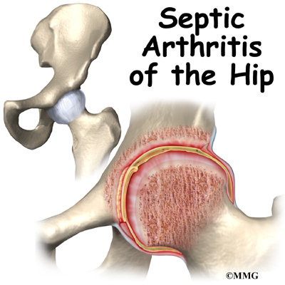 bone infection  child_hip_septic_int