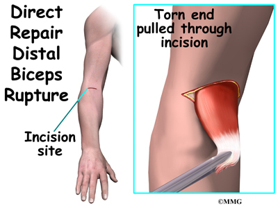 distal bicep tendon