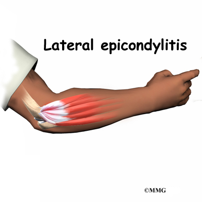 bilateral elbow pain