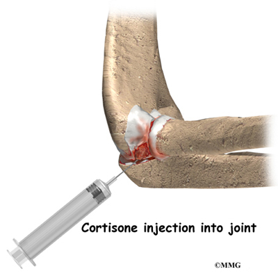 Steroid injection elbow bursitis