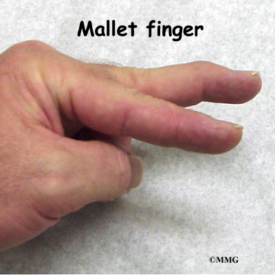 Treatment for mallet finger is usually nonsurgical If there is no fracture 