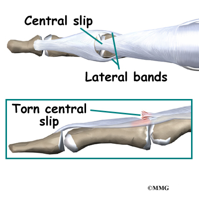 tendons in hand. where the extensor tendon