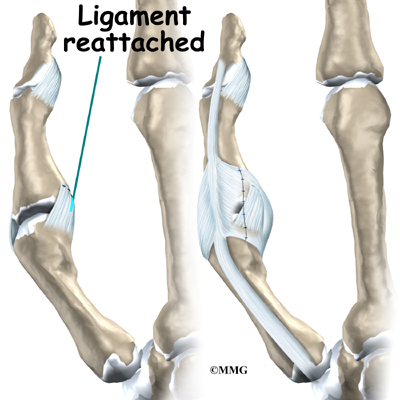 Ligament reattached