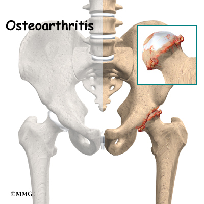 What is osteoarthritis of the hip?