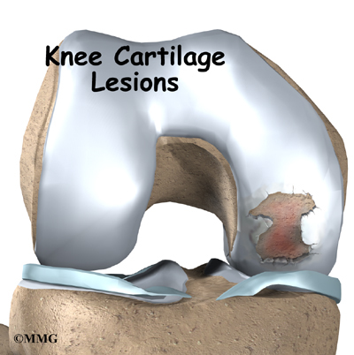 Weight Loss Seems to Spare Knee Cartilage