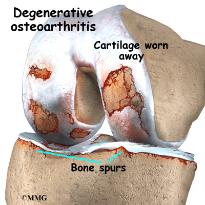 اصابات مفصل الركبه ....وعلاجها knee_osteoarth_anatomy02.jpg