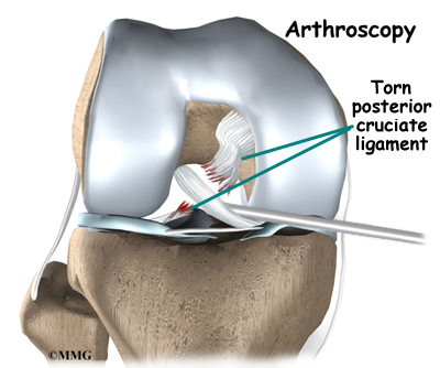 Torn  on Posterior Cruciate Ligament Injuries   Orthogate