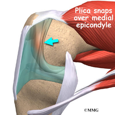 knee_plica_symptom01.jpg