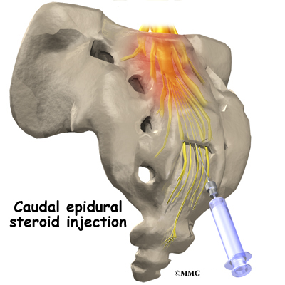 Steroid shot back pain meningitis