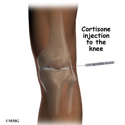 Corticosteroid injections knee pain