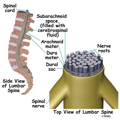 What is spinal fluid leak?