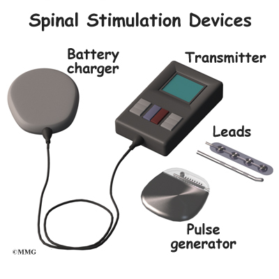 Dorsal Column (Spinal Cord) Stimulation.