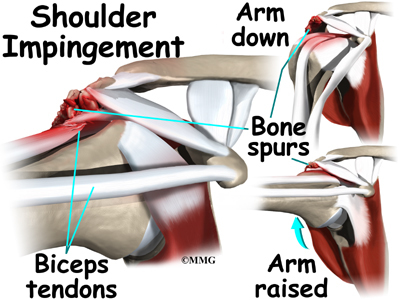 What is the typical recovery time following shoulder impingement surgery?