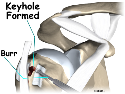 biceps rupture tendonitis tendon shoulder bicipital keyhole groove surgery tear torn burr eorthopod tenodesis does cavity same width made shaped