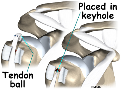 Picutre of Tendon Ball in Keyhole