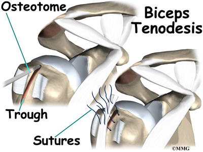biceps tendon tenodesis shoulder rupture bicep surgery torn groove after procedure fixed acromioplasty rehabilitation bone hole humerus patient