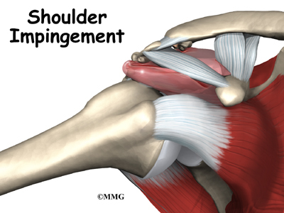 Physical Therapist's Guide to Shoulder Impingement