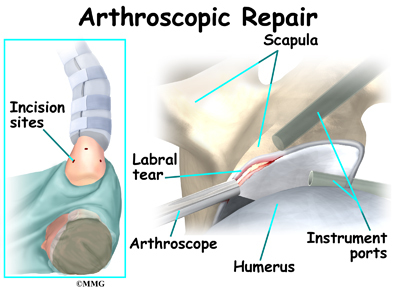 labral tears shoulder debridement tear labrum surgery repair procedure does open where eorthopod symptoms frayed