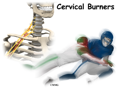 injury in football. Injury to the nerves of the