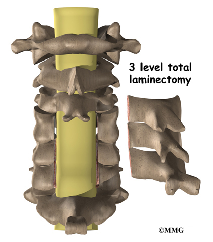 What is the procedure used in laminectomy surgery?