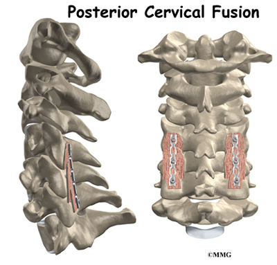 Cervical Spinal Fusion