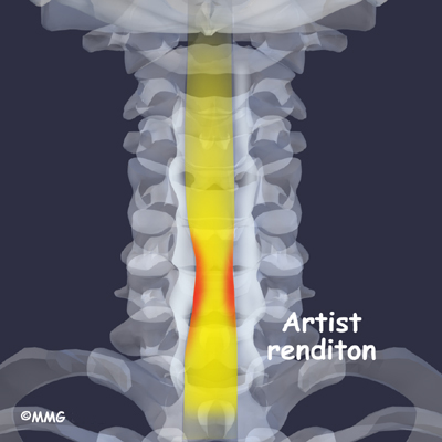 What are bone spurs in the neck?
