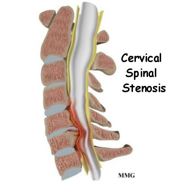 What treatment options are available for cervical stenosis?