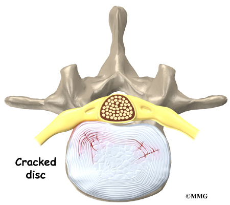 Crack Lower Spine