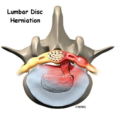 Lumbar Disc Herniation - Orthogate