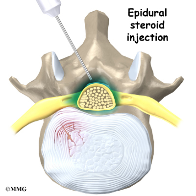 Lumbar epidural steroid injections for low back pain