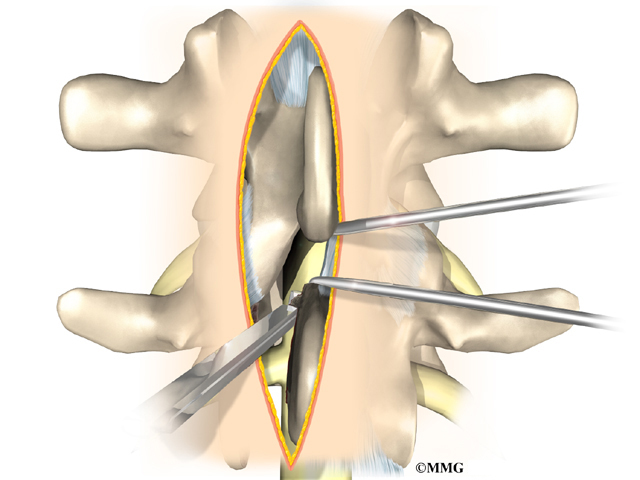What is the procedure used in laminectomy surgery?