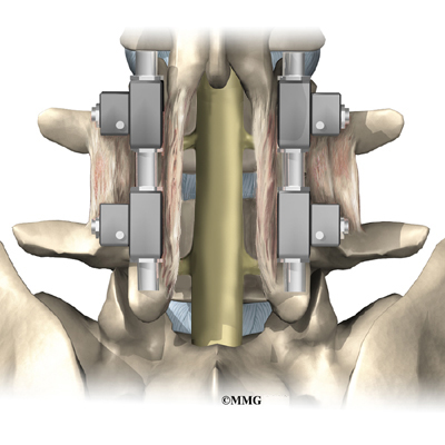 What is involved in spinal fusion surgery?