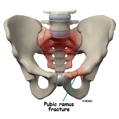 What are the symptoms of a fractured pelvis?