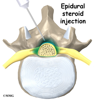 Epidural morphine and steroid paste complications