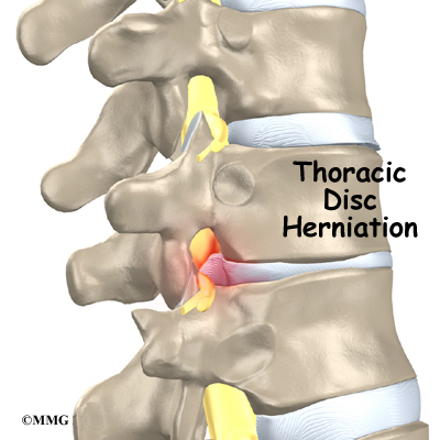 herniation of brain. Thoracic Disc Herniation