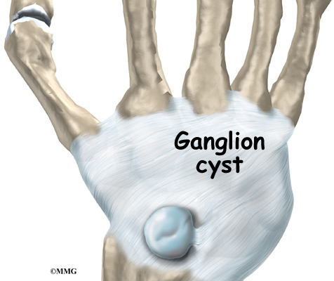 the ganglion wrist_ganglion_intro