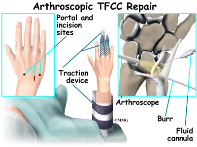 Carpal tunnel steroid injection recovery