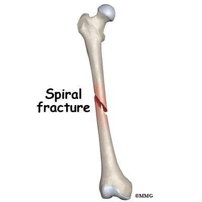 Pictures Of Spiral Fractured Femur 84