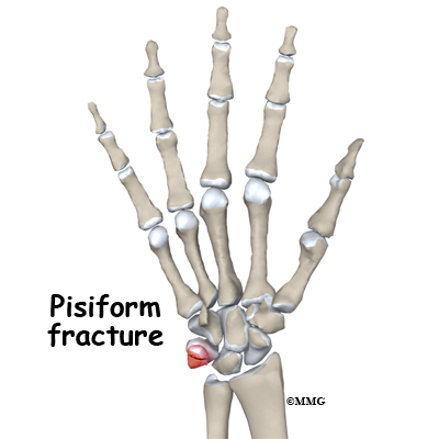 Wrist Pisiform