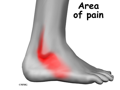 Steroid injection for pain in foot
